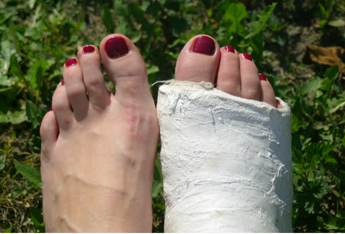 ギプスシーネとシーネ固定は似ているけど全然違うから要注意 医事ラボ